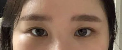 Mình hoàn toàn hài lòng sau khi làm mở rộng góc mắt kép.