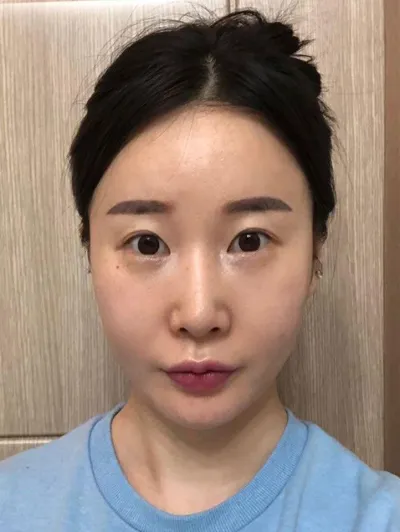 Đã 3 tháng kể từ khi mình phẫu thuật lại tại Very Good rồi!