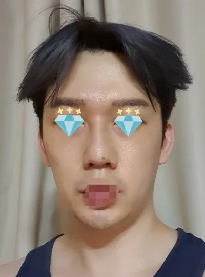 Hình như mình làm mũi thành công mỹ mãn luôn rồi haha.