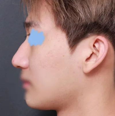 Đây là review sau 1 tháng mình phẫu thuật mũi tại Bệnh viện thẩm mỹ Very Good!