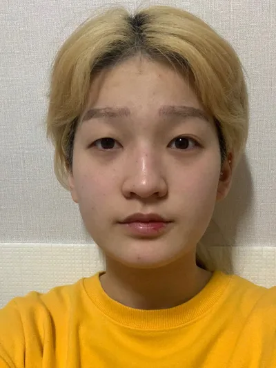 Đã 4 tháng kể từ khi phẫu thuật, mình không cần trang điểm nữa!!