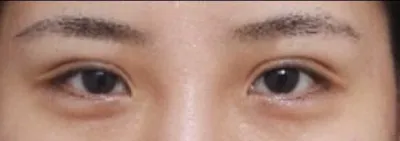 Tạm biệt đôi mắt xúc xích của mình nhé~