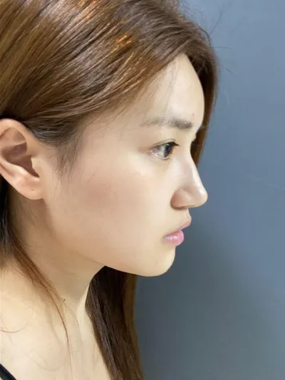 Mình vừa xem ảnh trước và sau phẫu thuật với Viện trưởng Lim Young-min rồi cùng đồng tình là phẫu thuật rất thành công về đây kk