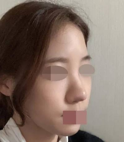 Những ai chỉ tiêm filler mũi hay đang cân nhắc phẫu thuật mũi thì đừng chần chừ nữa, mình thực sự khuyên các bạn nên phẫu thuật! Mình cực kỳ, cực kỳ giới thiệu Viện trưởng Lim!!