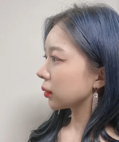 Review chỉnh sửa mũi gồ tại Very Good sau 9 tháng của mình!