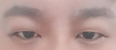 Mình đã phẫu thuật chỉnh hình mắt không cắt.