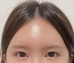 Đây là review 4 tháng căng da trán của mình~~