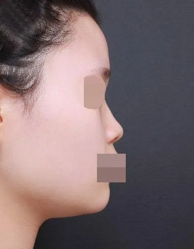 Đây là review sau một tháng phẫu thuật mũi của mình.