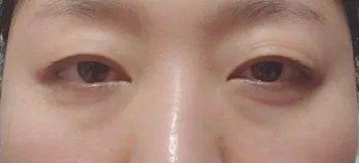 Đã hơn 3 tháng kể từ khi mình phẫu thuật tái định vị mỡ dưới mắt rồi.