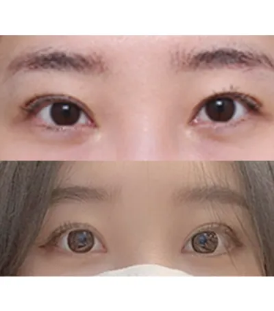 Mình phẫu thuật được hơn một tháng một chút rồi.