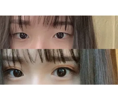 Trước khi phẫu thuật mình đã lo lắng vì mắt có nhiều nếp nhăn, nhưng kết quả thực sự đúng như những gì mình mong muốn.