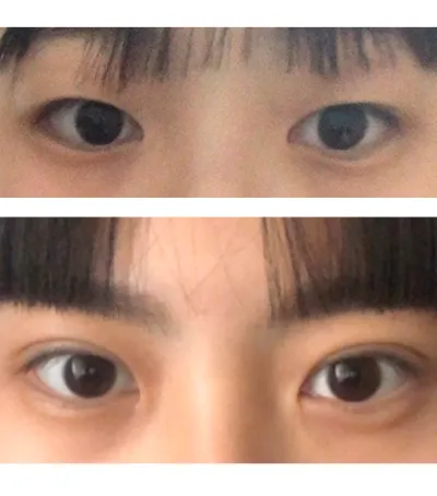 Ảnh sau phẫu thuật là mắt mình sau khi cắt mí được khoảng 38 ngày!