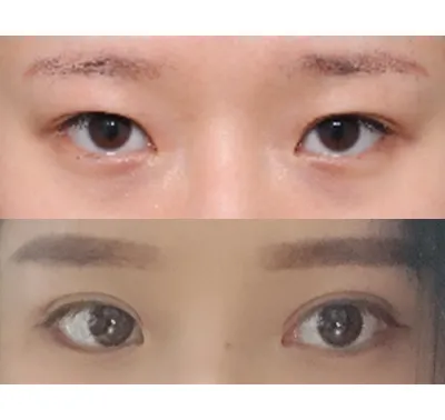 Mình đã chọn phẫu thuật lại vì trước đây sau khi cắt mí, mí mắt cứ dần bị ẩn vào trong khiến mình luôn cảm thấy stress.