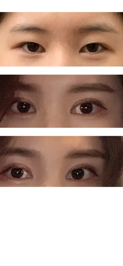 Review của mình về phẫu thuật cắt mí mắt lại phương pháp rạch, mở rộng góc mắt sau và dưới (mở rộng góc mắt kép phương pháp rạch), chỉnh hình sụp mí phương pháp rạch.