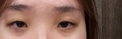 Mình đã phẫu thuật mắt lần đầu tại Bệnh viện thẩm mỹ Very Good.