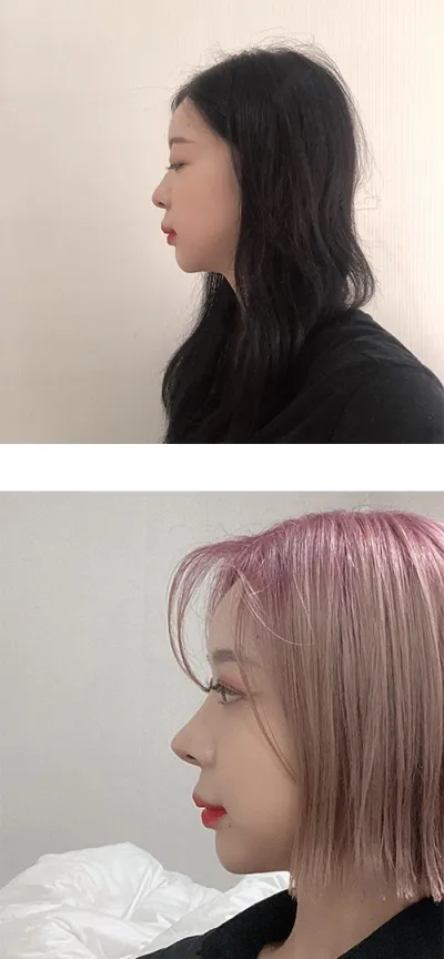 Review phẫu thuật mũi sau 6 tháng của mình.