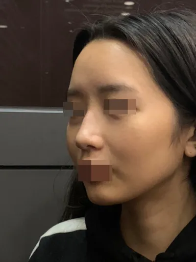 Mình đã phẫu thuật mũi lần đầu tại Very Good! Rất tuyệt vời!