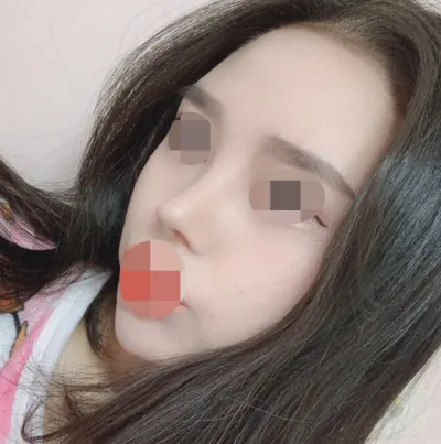 Mình đã nâng mũi lần đầu, làm sống mũi, đầu mũi, chỉnh mũi ngắn và thu gọn cánh mũi.