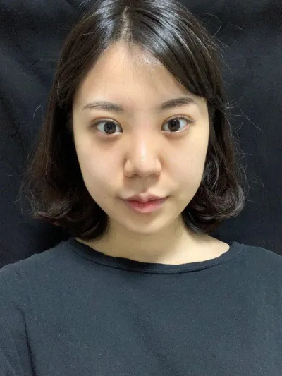 Sau một thời gian, vết sưng đã giảm hết nên mọi thứ trông rất tự nhiên và vào form mà không có chỗ nào bị gượng gạo, mình thấy rất hài lòng. Very good~!!