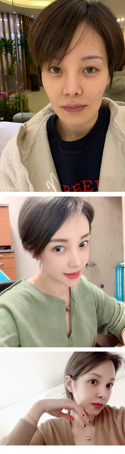 Có vẻ như đã gần 1 năm rồi. Tình trạng mặt hơi gồ ghề của mình cũng đã cải thiện nhiều rồi haha. Vì đường nét khuôn mặt đã cải thiện hơn một chút nên mình cũng hay chụp ảnh tự sướng hơn haha.