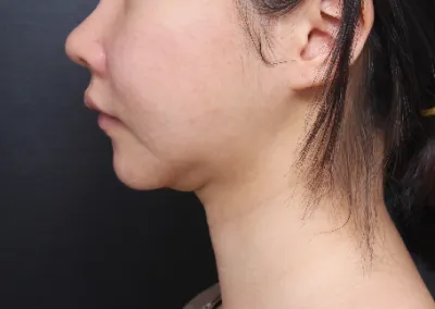 Họ chăm sóc cho mình rất tỉ mỉ từng chút một từ việc cắt chỉ đến hậu phẫu. Vì hút mỡ không bị yo-yo nên những ai đang băn khoăn về hút mỡ hãy thử đến Very Good nhé.