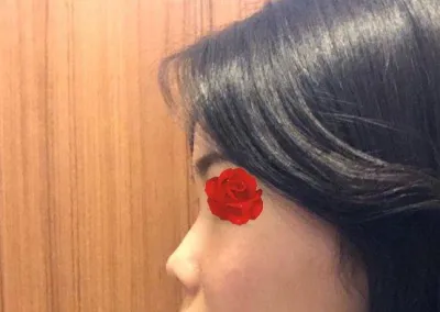 Mình nghĩ rằng nếu phẫu thuật với bác sĩ khác thì chắc chắn sẽ không đạt được độ cao như thế này, nên mình hoàn toàn không hối hận chút nào~~!!