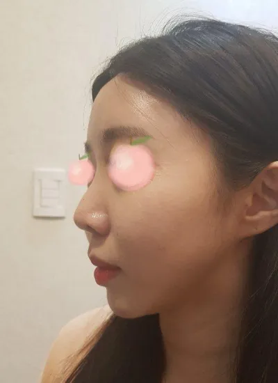 Mình đã nâng mũi bằng sụn sườn tự thân, hiện tại mình đang rất hài lòng ㅋㅋㅋㅋ