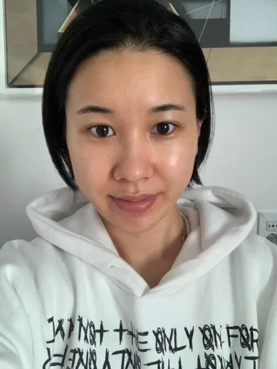 Đã 6 tháng kể từ khi mình phẫu thuật rồi~! Mình để lại review đây~