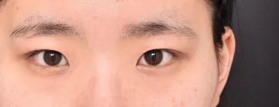 Thấm thoát đã được 4 tháng kể từ khi mình cắt mí rồi 'ㅜ'!!!