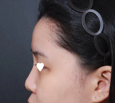 Mình đã phẫu thuật mũi chỗ Viện trưởng Lim Young-min nè ㅎㅎ