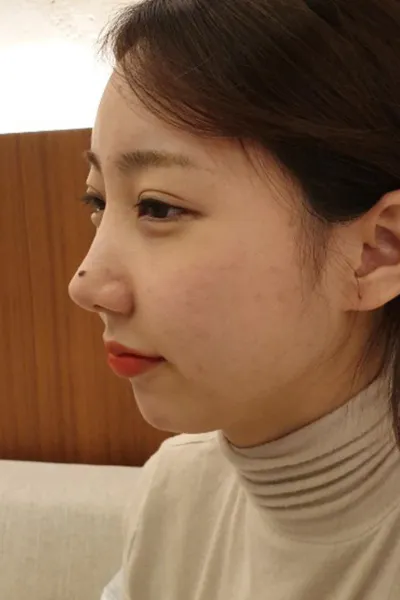 Vì mình bị lẹm cằm nên mình đã phẫu thuật độn cằm!!