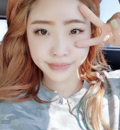 Đã được 3 tháng kể từ khi mình phẫu thuật rồi! Mình nghĩ là vết sưng cũng đã giảm hết rồi.