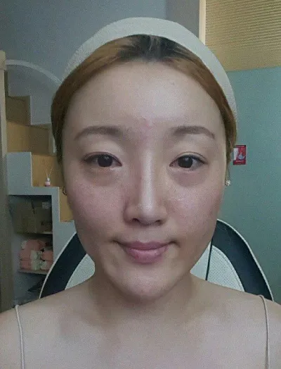 Review sau 3 tháng cắt mí, lấy mỡ mí dưới và gọt mặt 3 vùng của mình.