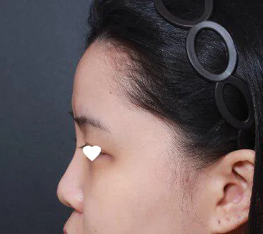 Mình đã phẫu thuật mũi tại Thẩm mỹ viện Very Good bởi Viện trưởng Lim Young-min hihi.