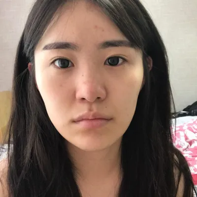 Mình phẫu thuật mũi được gần 4 tháng rồi!