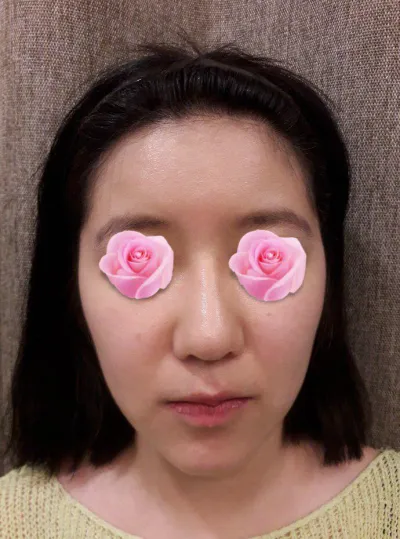 Đã được 2 tháng kể từ khi mình phẫu thuật. Mình đã làm lại mũi và phẫu thuật đường nét khuôn mặt (gò má, gọt hàm đường dài và cằm).