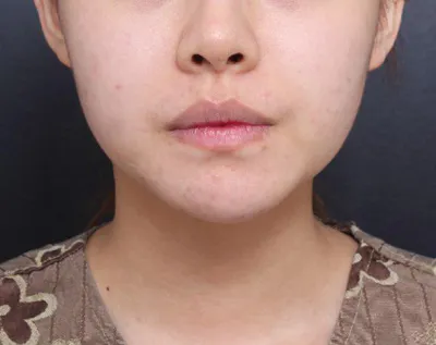 Đã được khoảng một tháng sau khi mình hút mỡ mặt, đường nét khuôn mặt cũng đã vào form rõ rệt và mình rất hài lòng!