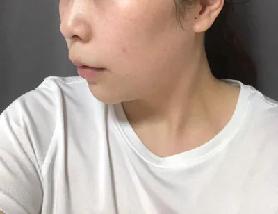 Đây là review sau một tháng mình hút mỡ nọng cằm và đường viền hàm~