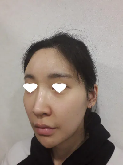 Phẫu thuật hạ gò má rất tự nhiên và mình rất hài lòng^^