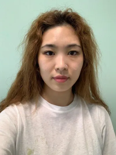 Review phẫu thuật mắt, mũi và thu gọn hàm của mình đây~~