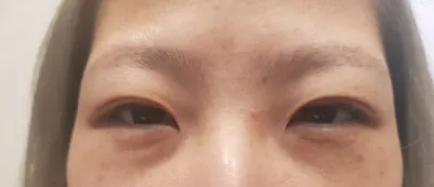 Mình đã phẫu thuật lại mắt hai mí bằng phương pháp cắt mí từ Viện trưởng Kim Jun-hyung.