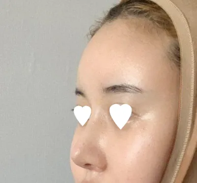 Mình đã được Bác sĩ Lim Young-min phẫu thuật lại mũi!!!