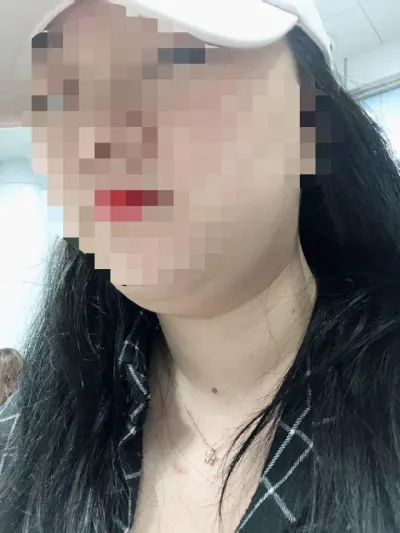 Mình luôn lo lắng về nọng cằm nên đã thực hiện hút mỡ mặt.