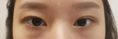 Đây là ảnh sau khi phẫu thuật được gần 3 tháng~~ Mình để lại review đây!!~