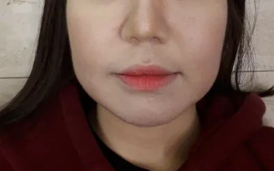 Mình thực sự cảm ơn Viện trưởng Kim Jun-hyeon vì đã tư vấn nhanh chóng, đưa ra phác đồ rõ ràng và mang lại kết quả thủ thuật khiến mình hài lòng!