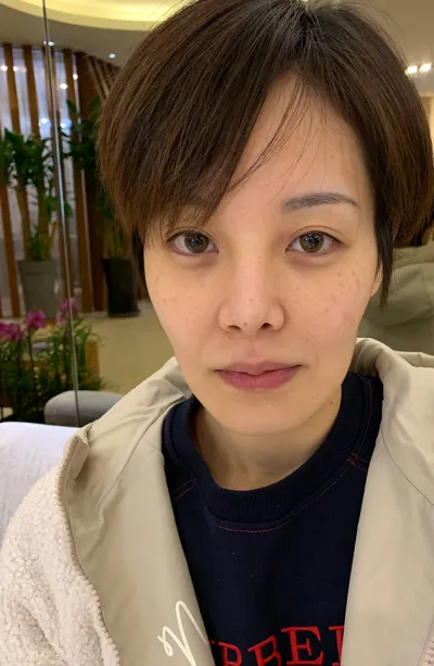 Mình chia sẻ review sau 6 tháng phẫu thuật Elasticum!!