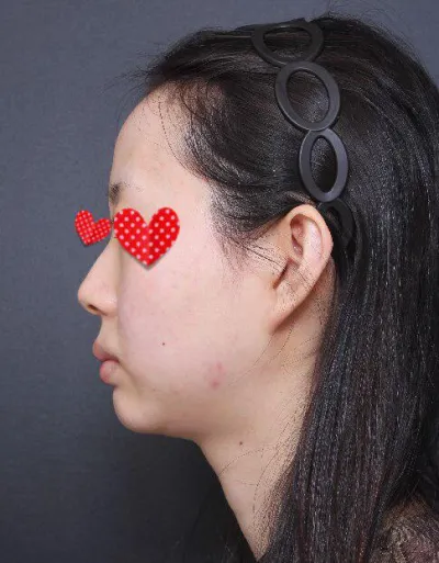 Mình làm mũi và cấy mỡ được 3 tuần rồi, bao nhiêu stress vì mũi lân, mũi gồ, trán lõm và cằm đều tan biến hết sạch.