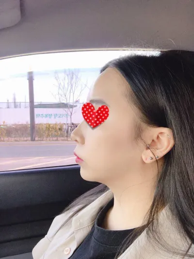 Mình đã thực hiện cấy mỡ toàn mặt tại Bệnh viện thẩm mỹ Very Good vào ngày 9 tháng 4.