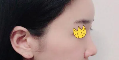 Mình làm lại mũi được 3 tháng rồi^^