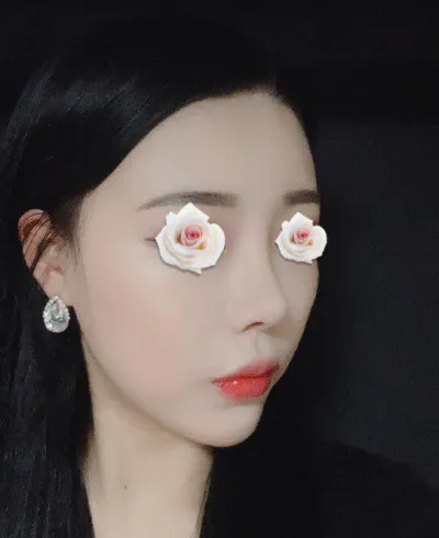 Đã tròn một tháng kể từ khi mình phẫu thuật nâng mũi với Viện trưởng Lim Young-min.